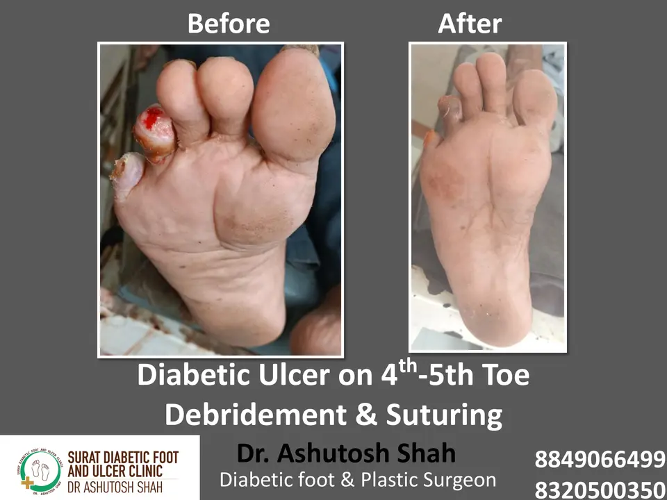 Diabetic Foot  PPT sunita.pptx-44.webp